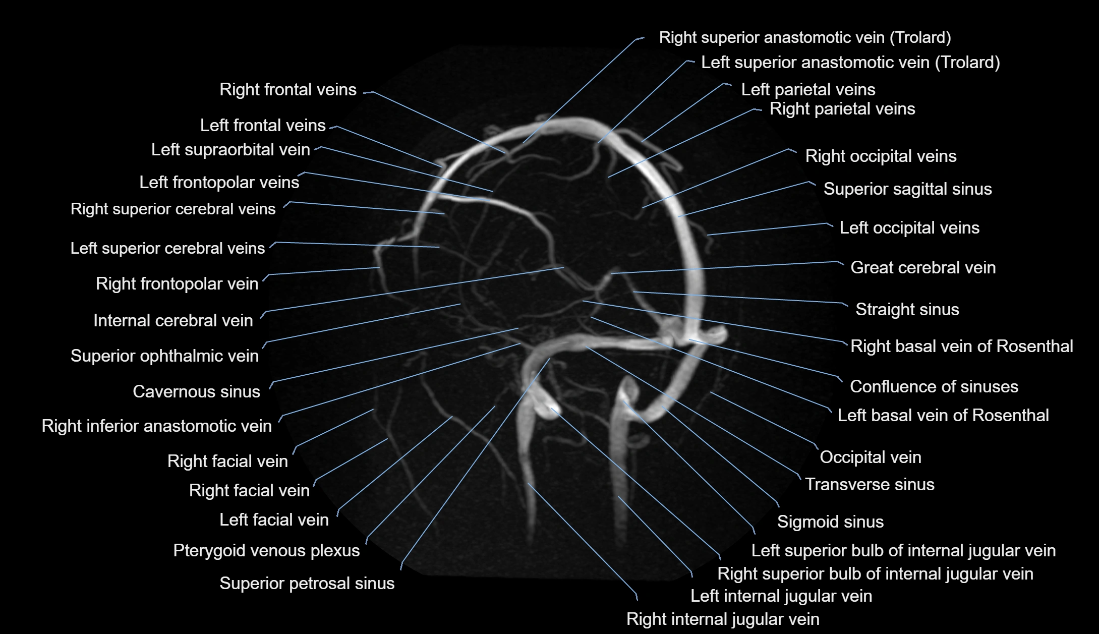 MRV brain MIP sagittal labelled anatomy 3T MRI images -img-1011001-00004.webp